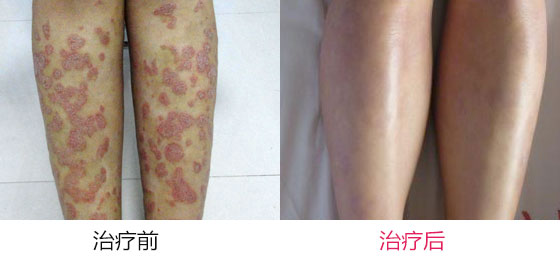 牛皮癣症状