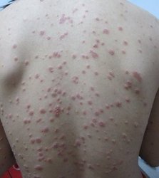 牛皮癣症状