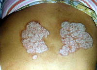 牛皮癣(银屑病)传染吗